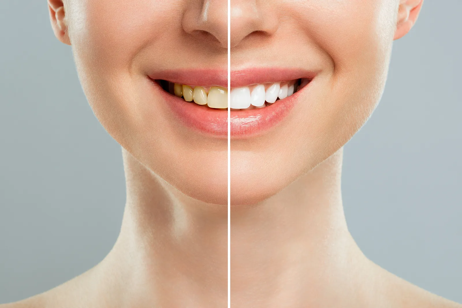 Smile Makeover